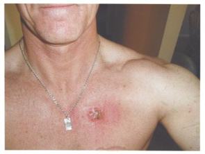 Robert Black skin cancer tumor on chest
