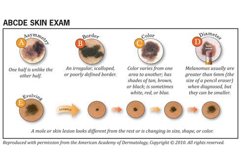 Skin Cancer ABCDE Self Exam