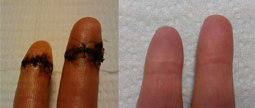 Cut fingers healed with squalane oil